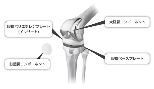 術 関節 人工 膝 置換 膝における人工関節置換術の種類と適応目安