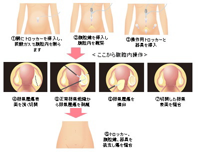 卵巣 の う 腫 症状 チェック